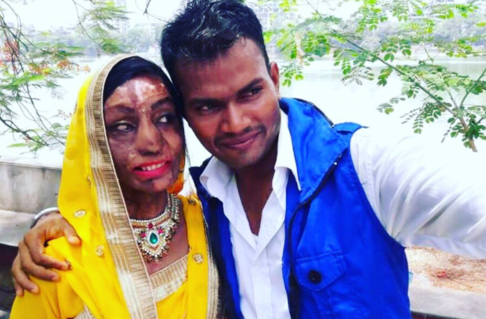 After Accidental Meeting Acid Attack Survivor Falls In Love Marries
